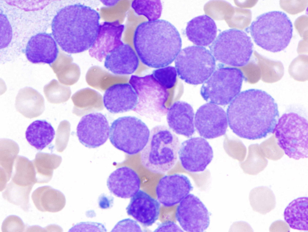 B. Bone marrow aspirate showing increased blasts with similar morphology as those present in the peripheral blood (H&E, 1000x oil).